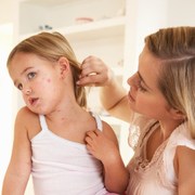Shingles related image